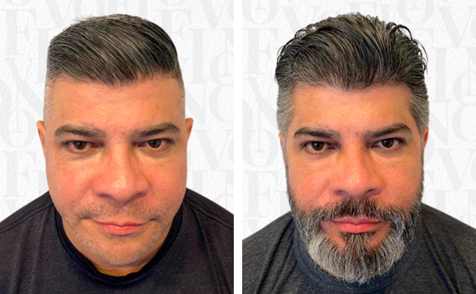 Transplante de Barba