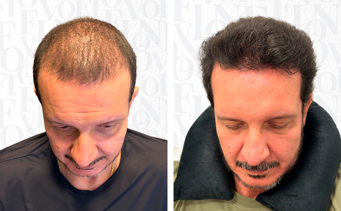 Transplante Capilar – FUE