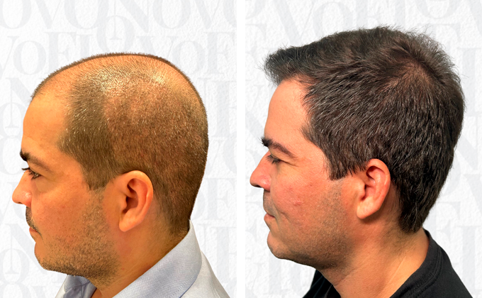 Transplante Capilar – FUE