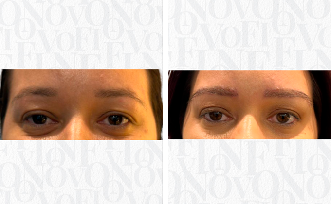 Transplante de Sobrancelha