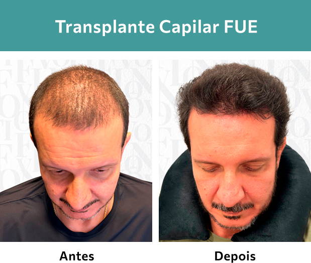 Transplante Capilar FUE