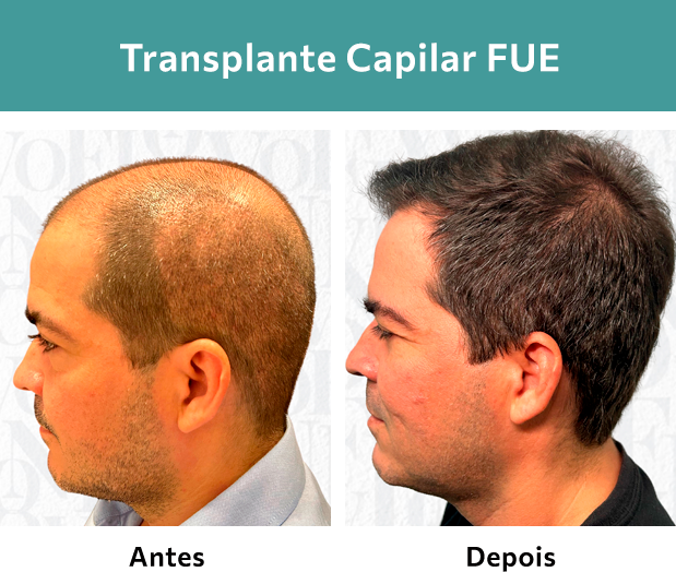 Transplante Capilar FUE
