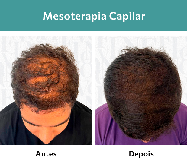 Mesoterapia Capilar