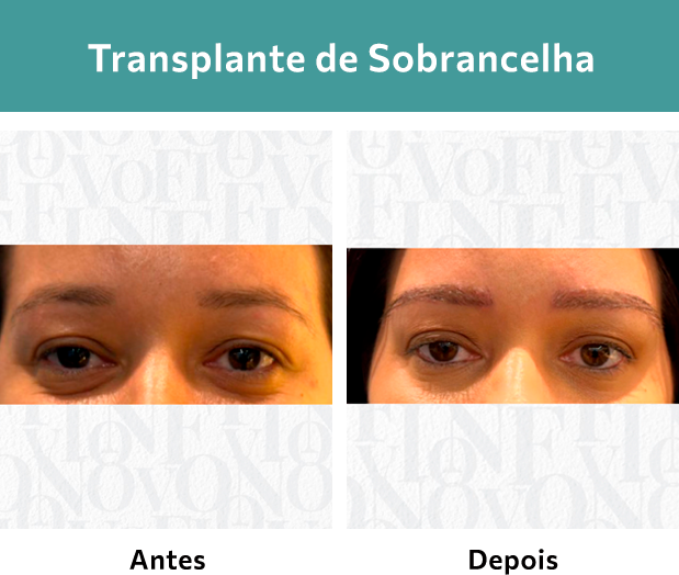Transplante de Sobrancelha