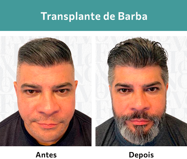 Transplante de Barba