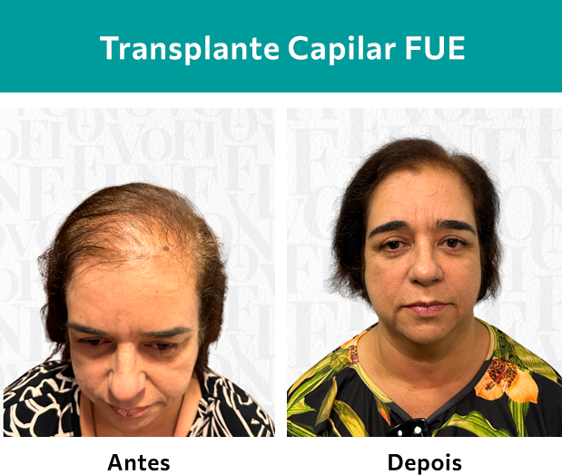 Transplante Capilar FUE