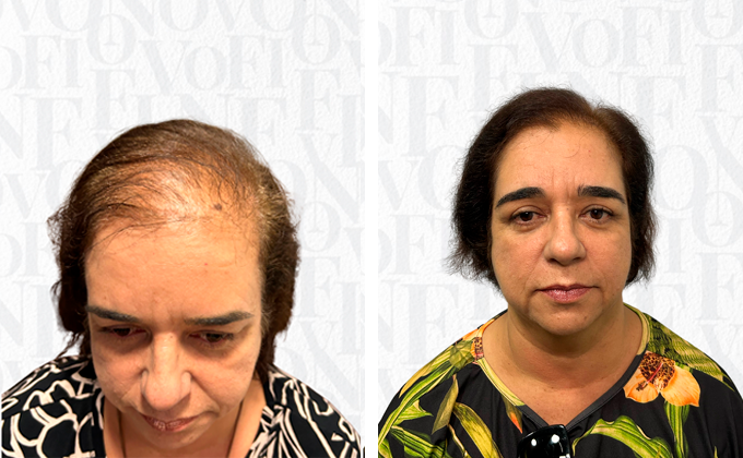 Transplante Capilar – FUE