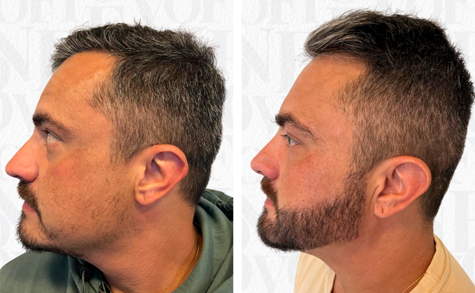 Transplante de Barba