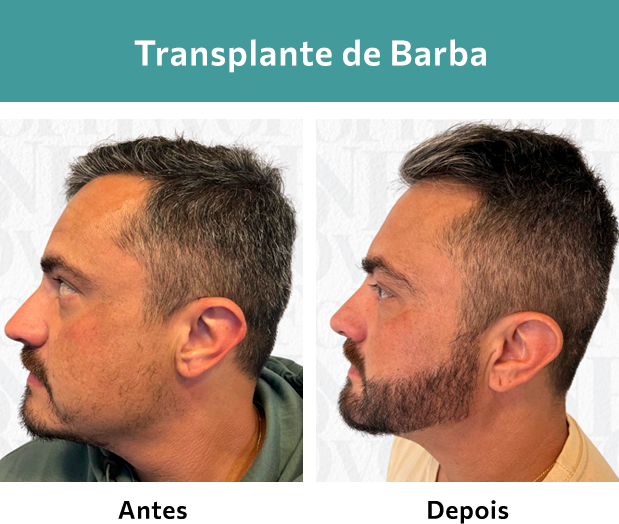 Transplante de Barba